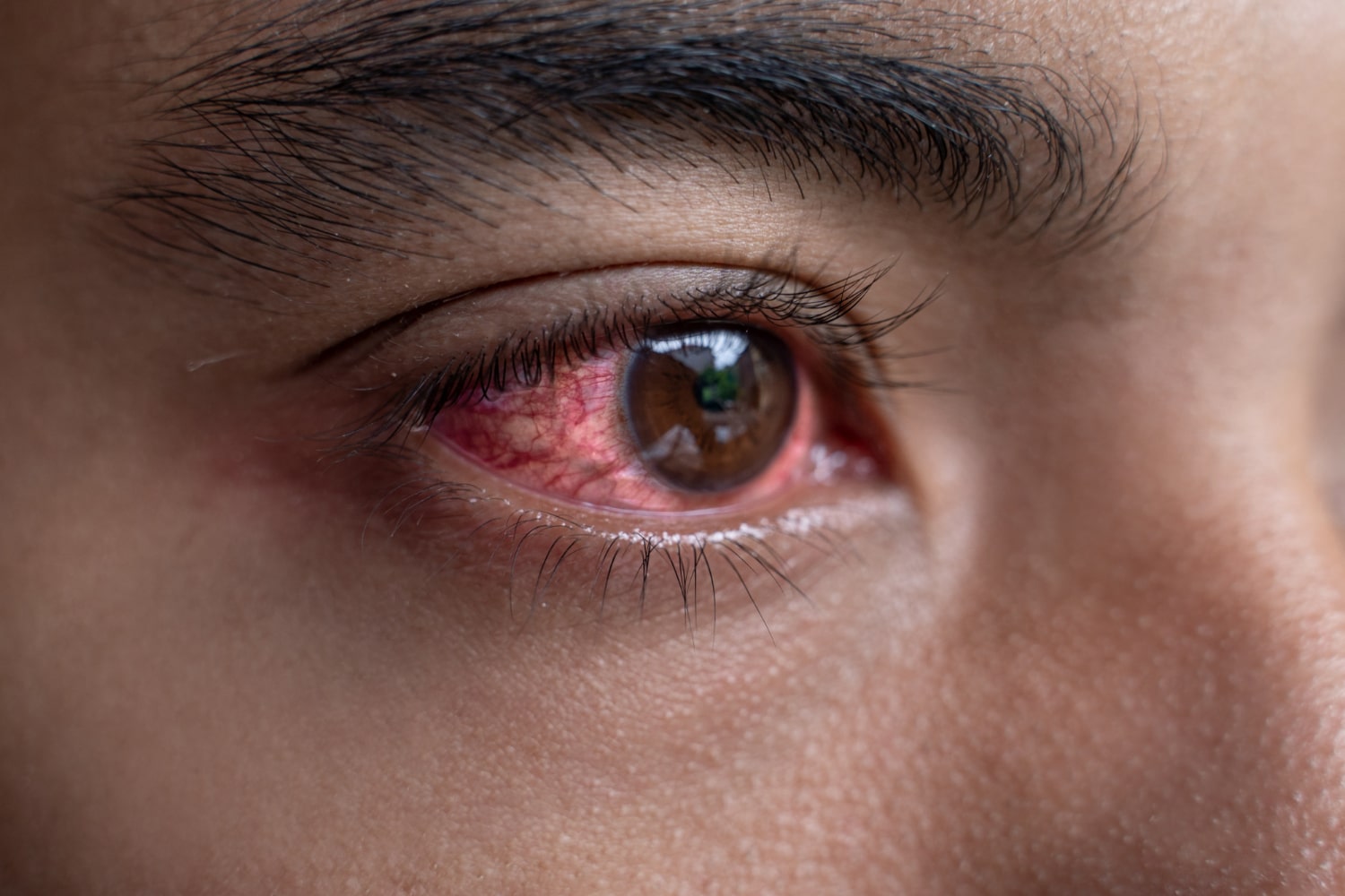 טיפול בעיניים אדומות