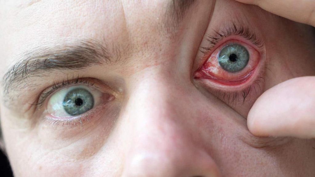 אלרגיות בעיניים