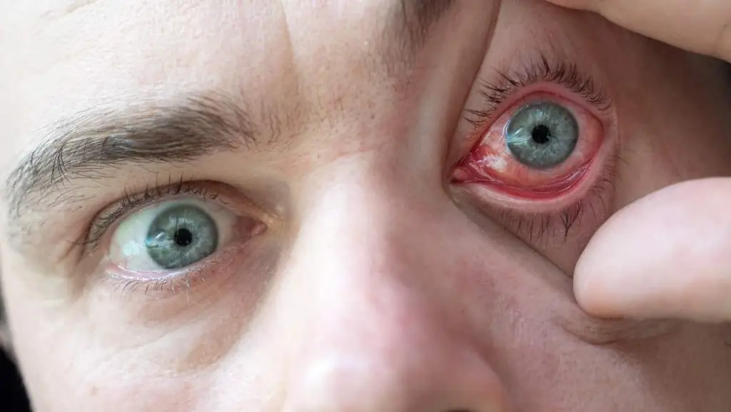 Allergies in the eyes
