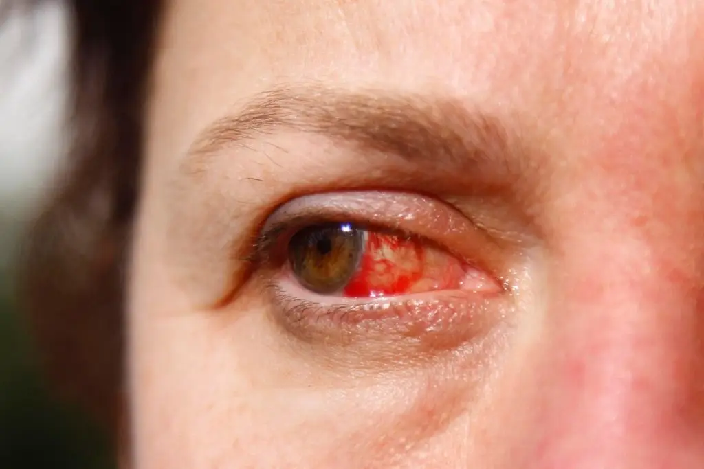 Allergies in the eyes