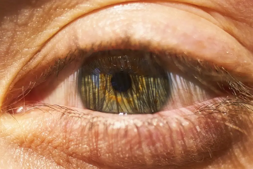 Swelling of the eye