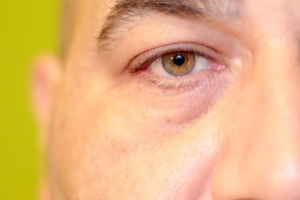 Swelling of the eye