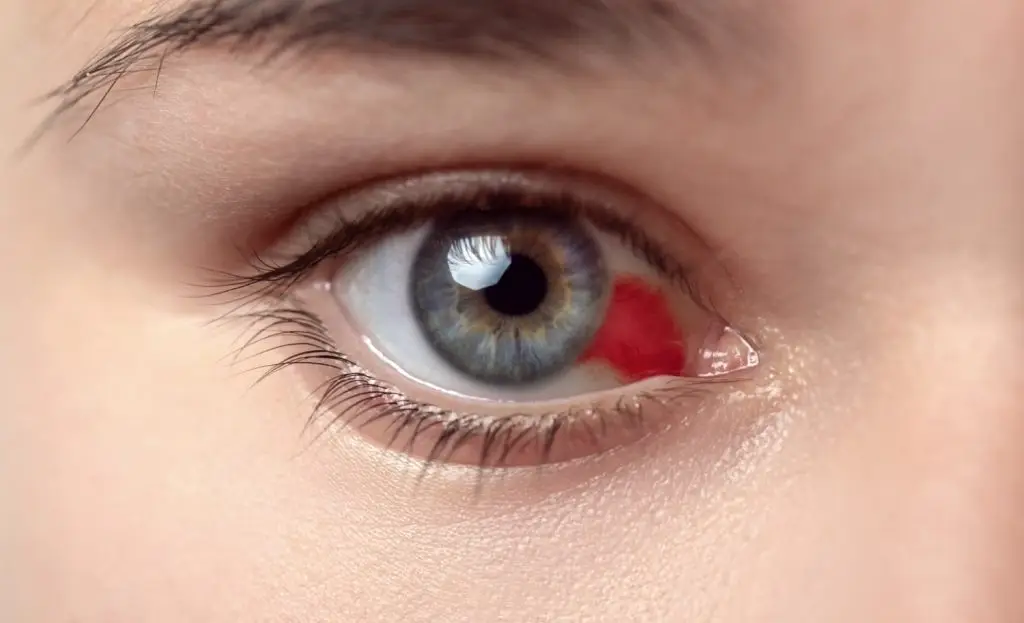 A red dot in the eye